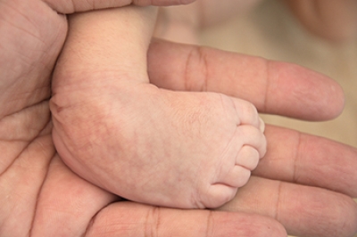 Types of Congenital Foot Problems