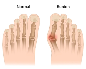 Understanding the Causes of Bunion Pain
