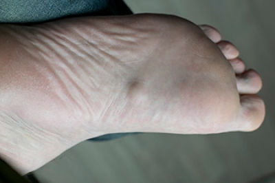 Plantar Fibromatosis