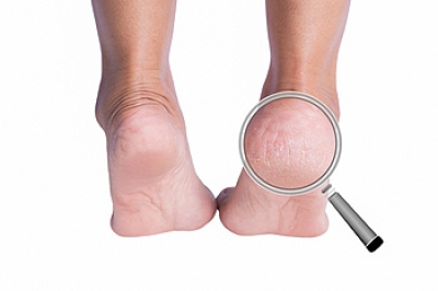 Cracked Heels and Their Link to Health Issues