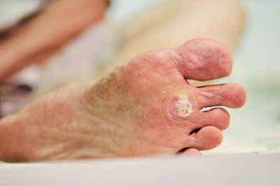 Symptoms and Transmission of Plantar Warts