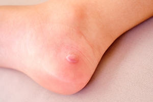 How to Avoid Development of Blisters