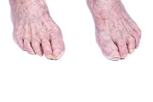 Foot Changes as People Age