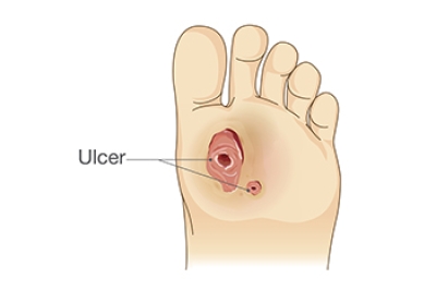 Diabetic Foot Ulcers Is a Condition You Cannot Ignore