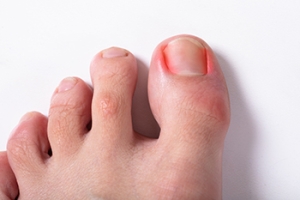 Painful Ingrown Toenails