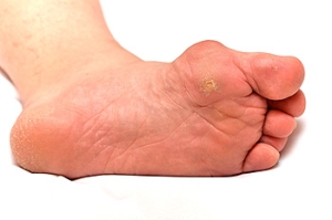 Managing Corns on the Feet